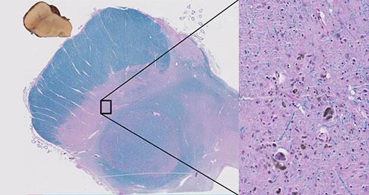 Neuropathology image 2
